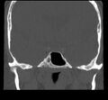 Acute sinusitis (Radiopaedia 23161-23215 Coronal bone window 54).jpg