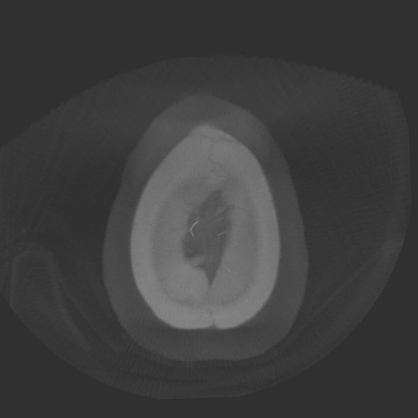 Acute subarachnoid hemorrhage and accessory anterior cerebral artery (Radiopaedia 69231-79010 Axial arterial - MIP 85).jpg