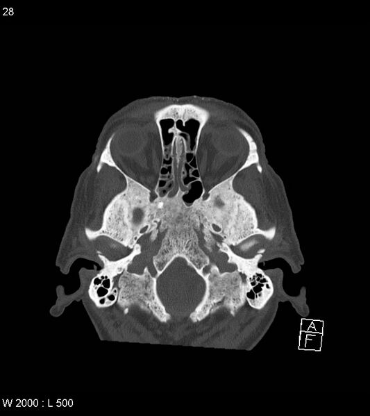 File:Acute subdural hematoma with myelofibrosis (Radiopaedia 52582-58494 Axial bone window 14).jpg