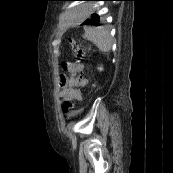 File:Acute tubular necrosis (Radiopaedia 28077-28334 H 72).jpg