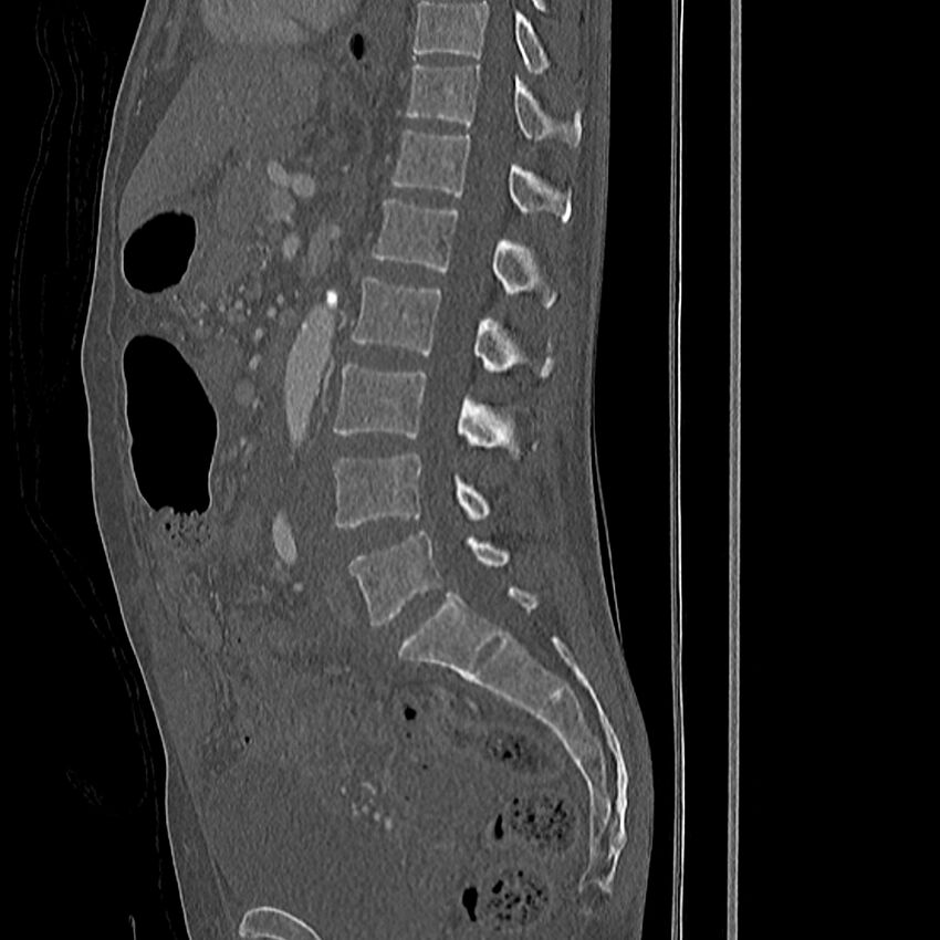 Acute vertebral body compression fractures (Radiopaedia 31757-32693 Sagittal bone window 24).jpg
