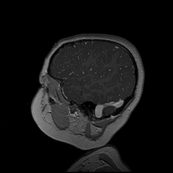 File:Adamantinomatous craniopharyngioma (Radiopaedia 77407-89529 H 21).jpg