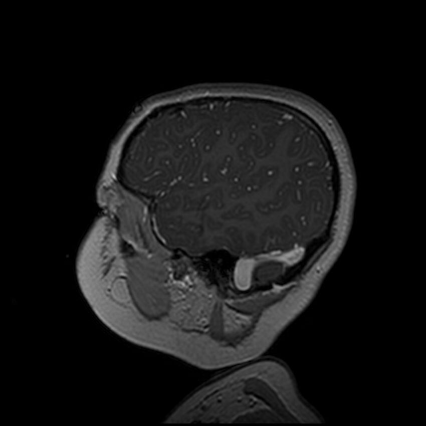 Adamantinomatous craniopharyngioma (Radiopaedia 77407-89529 H 21).jpg