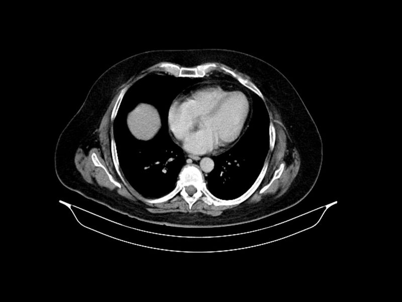File:Adenocarcinoma of pancreas with hepatic metastasis (Radiopaedia 64332-73122 Axial C+ delayed 10).jpg