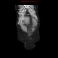 Adenocarcinoma of the colon (Radiopaedia 8191-9039 Coronal liver window 5).jpg