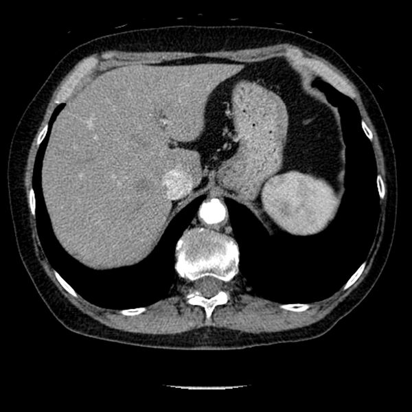 File:Adenocarcinoma of the lung (Radiopaedia 41015-43755 Axial C+ portal venous phase 110).jpg