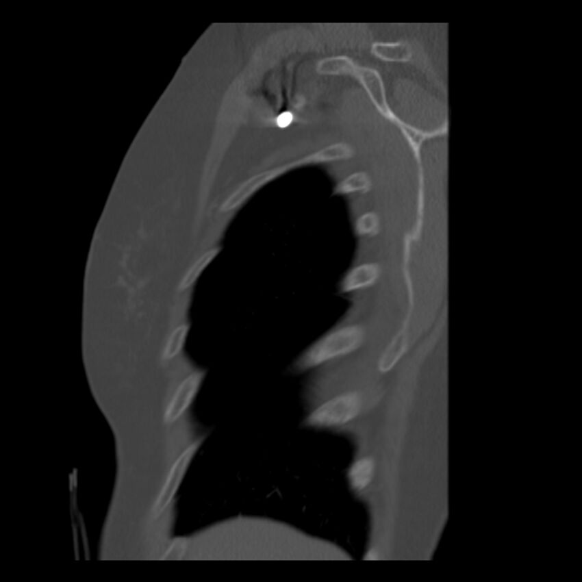 Adenocarcinoma of the lung (Radiopaedia 41015-43755 Sagittal bone window 7).jpg