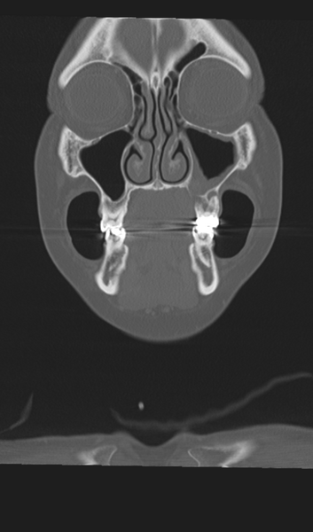 File:Adenoid cystic tumor of palate (Radiopaedia 46980-51518 Coronal bone window 18).png