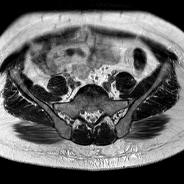 File:Adenomyoma of the uterus (Radiopaedia 9871-10439 Axial T2 29).jpg