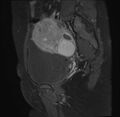 Adenomyosis - ovarian endometriomas (Radiopaedia 67031-76350 Sagittal T1 C+ fat sat 7).jpg