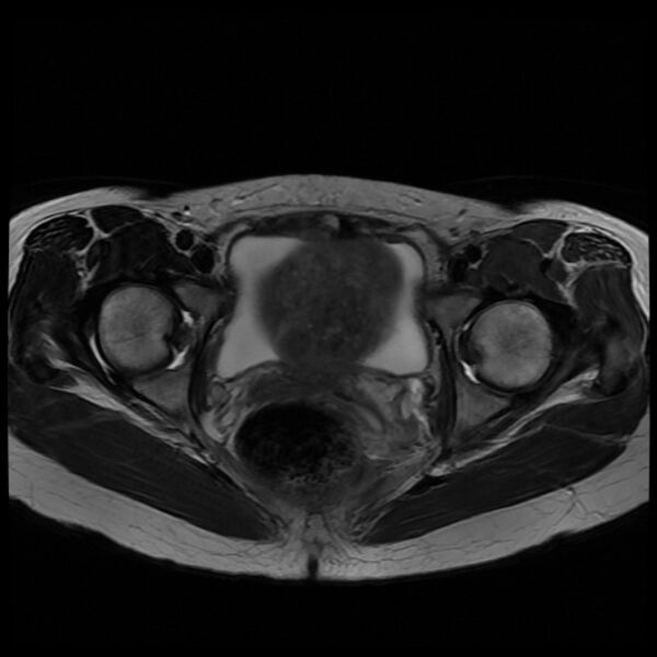 File:Adenomyosis on MRI (Radiopaedia 29328-29780 Axial T2 9).jpg