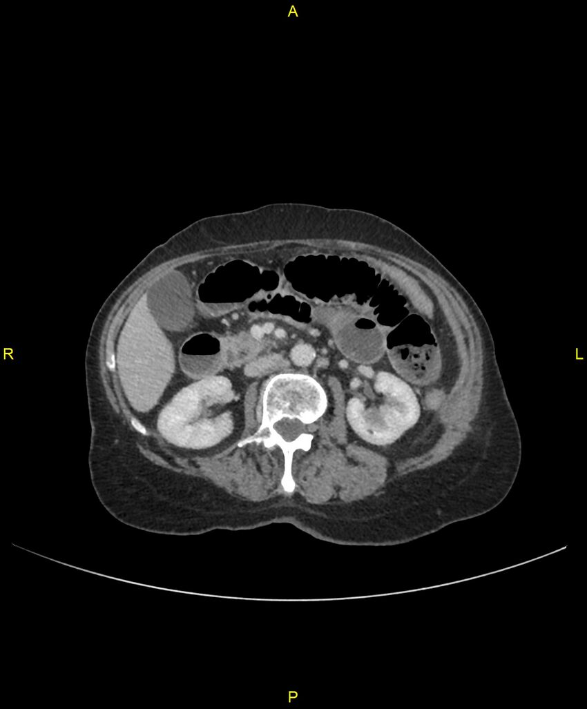 Adhesional small bowel obstruction (Radiopaedia 85402-101024 Axial C+ portal venous phase 116).jpg