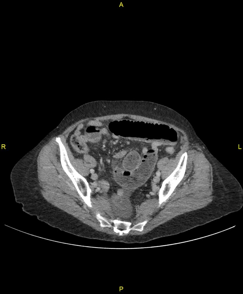 Adhesional small bowel obstruction (Radiopaedia 85402-101024 Axial C+ portal venous phase 227).jpg