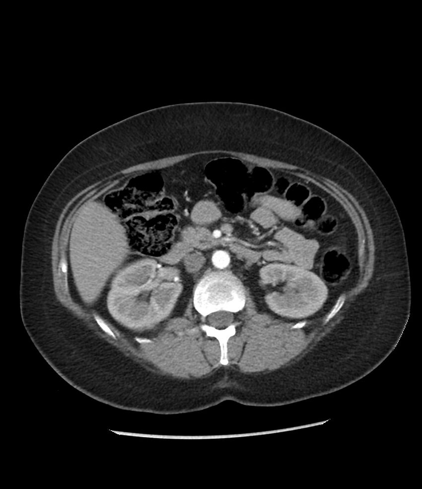 Adrenal cortical carcinoma with IVC invasion and thrombosis (Radiopaedia 34307-35597 Axial C+ arterial phase 37).jpg