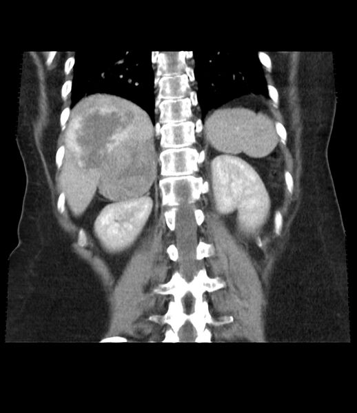 File:Adrenal cortical carcinoma with IVC invasion and thrombosis (Radiopaedia 34307-35597 Coronal C+ portal venous phase 37).jpg