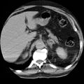 Adrenal hemangioma (Radiopaedia 11039-11445 Axial C+ delayed 4).jpg