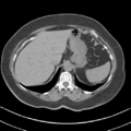 Adrenal hemangioma (Radiopaedia 33078-34103 Axial non-contrast 12).png