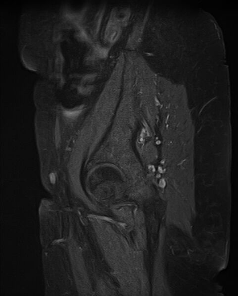 File:Adult granulosa cell tumor of the ovary (Radiopaedia 71581-81950 Sagittal T1 C+ fat sat 1).jpg