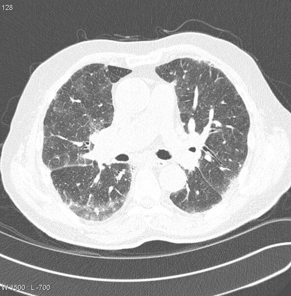 File:Amiodarone lung (Radiopaedia 6539-7851 Axial lung window 13).jpg