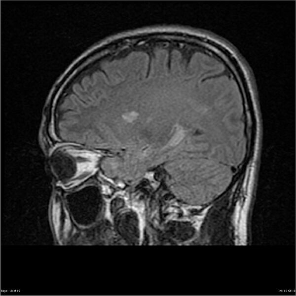 File:Amnestic syndrome secondary to hypoxic brain injury (Radiopaedia 24743-25004 D 18).jpg