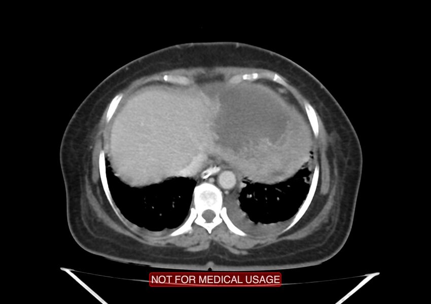 Amoebic enterocolitis with liver abscess (Radiopaedia 35100-36609 A 10).jpg