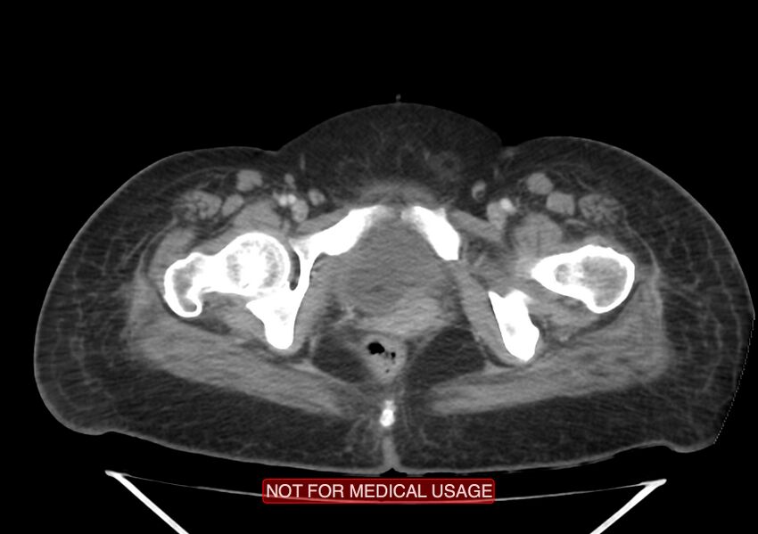 Amoebic enterocolitis with liver abscess (Radiopaedia 35100-36609 A 81).jpg