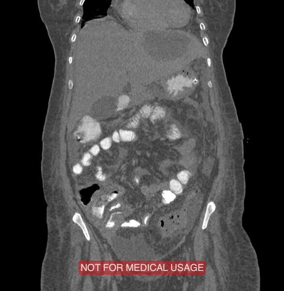 File:Amoebic enterocolitis with liver abscess (Radiopaedia 35100-36609 B 58).jpg