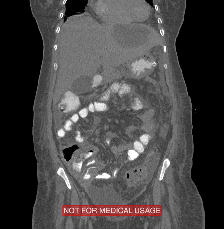 Amoebic enterocolitis with liver abscess (Radiopaedia 35100-36609 B 58).jpg