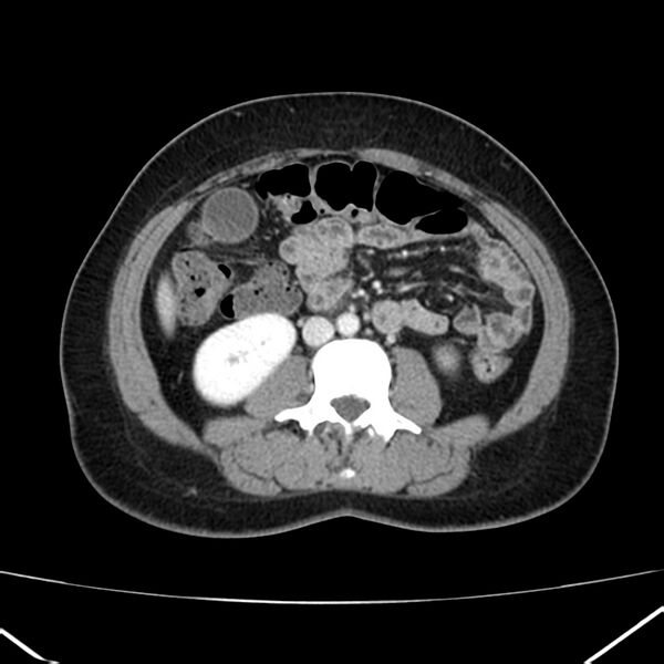 File:Ampullary tumor (Radiopaedia 22787-22816 C 35).jpg