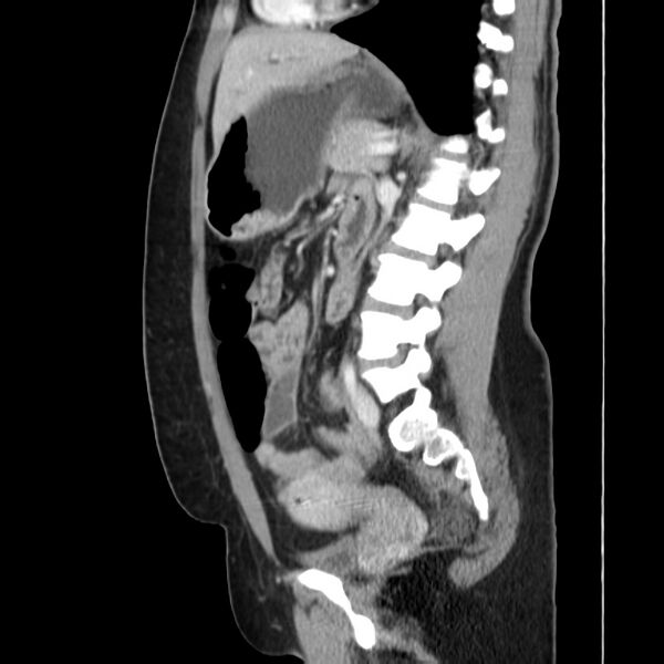 File:Ampullary tumor (Radiopaedia 22787-22816 D 33).jpg