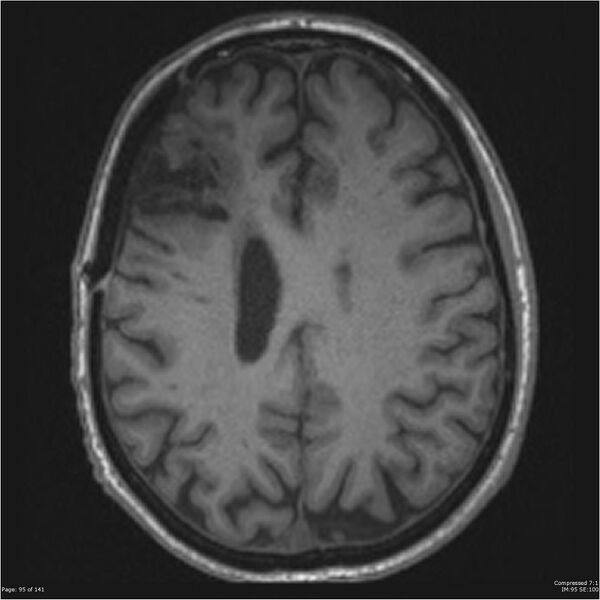 File:Anaplastic meningioma with recurrence (Radiopaedia 34452-35788 Axial T1 93).jpg