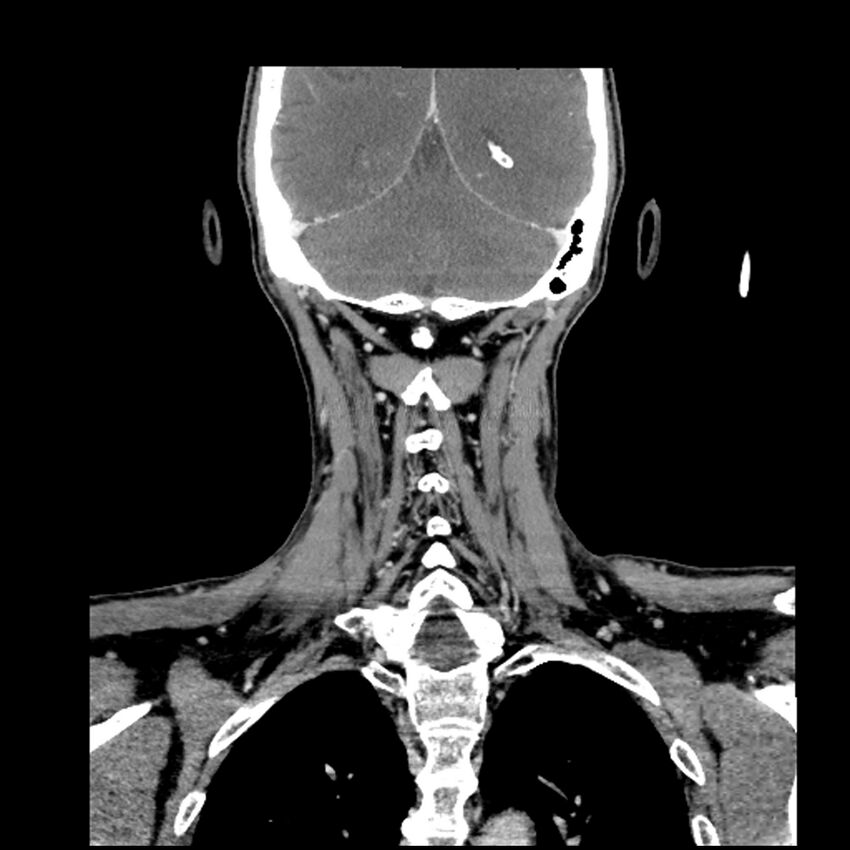 Anaplastic thyroid carcinoma (Radiopaedia 79087-92034 A 90).jpg