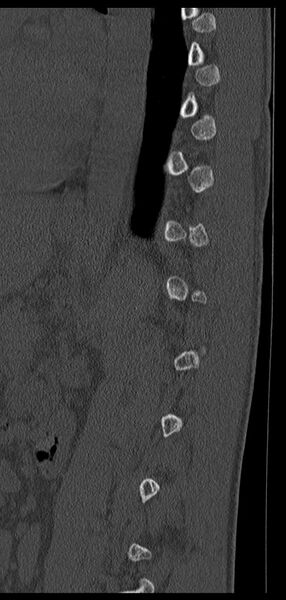 File:Aneurysmal bone cyst T11 (Radiopaedia 29294-29721 Sagittal bone window 23).jpg