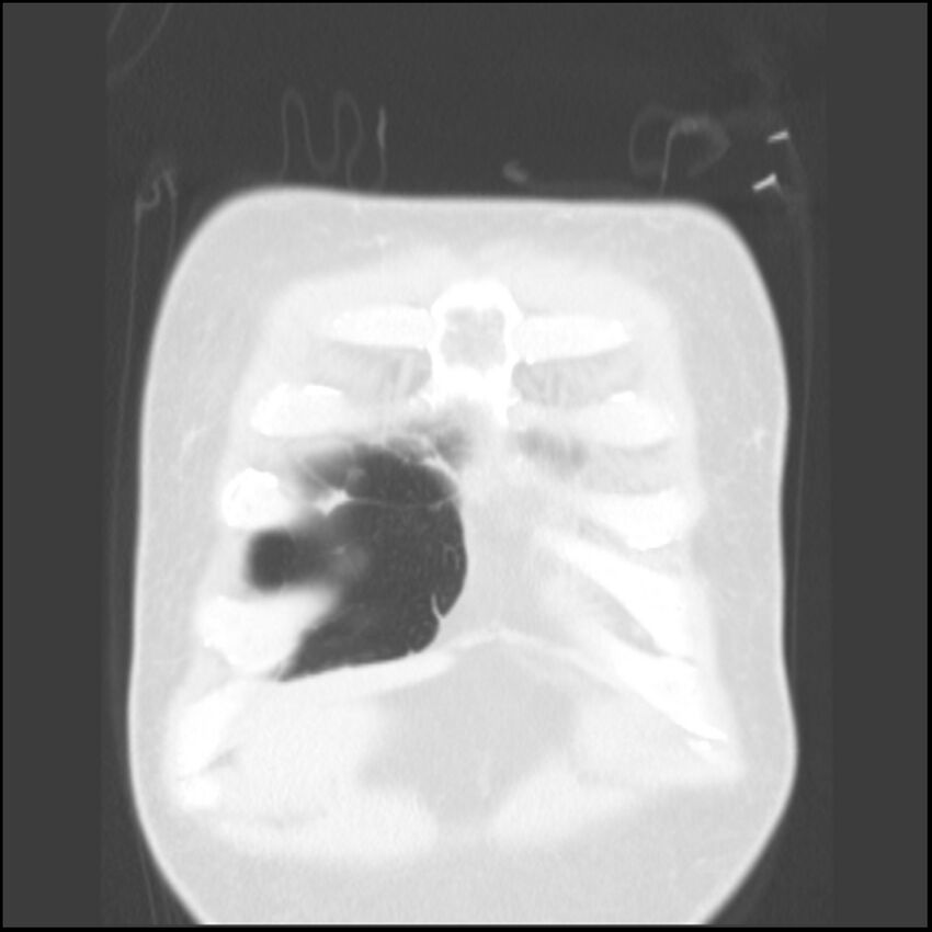 Angioinvasive aspergillosis (Radiopaedia 43957-47466 Coronal lung window 85).jpg
