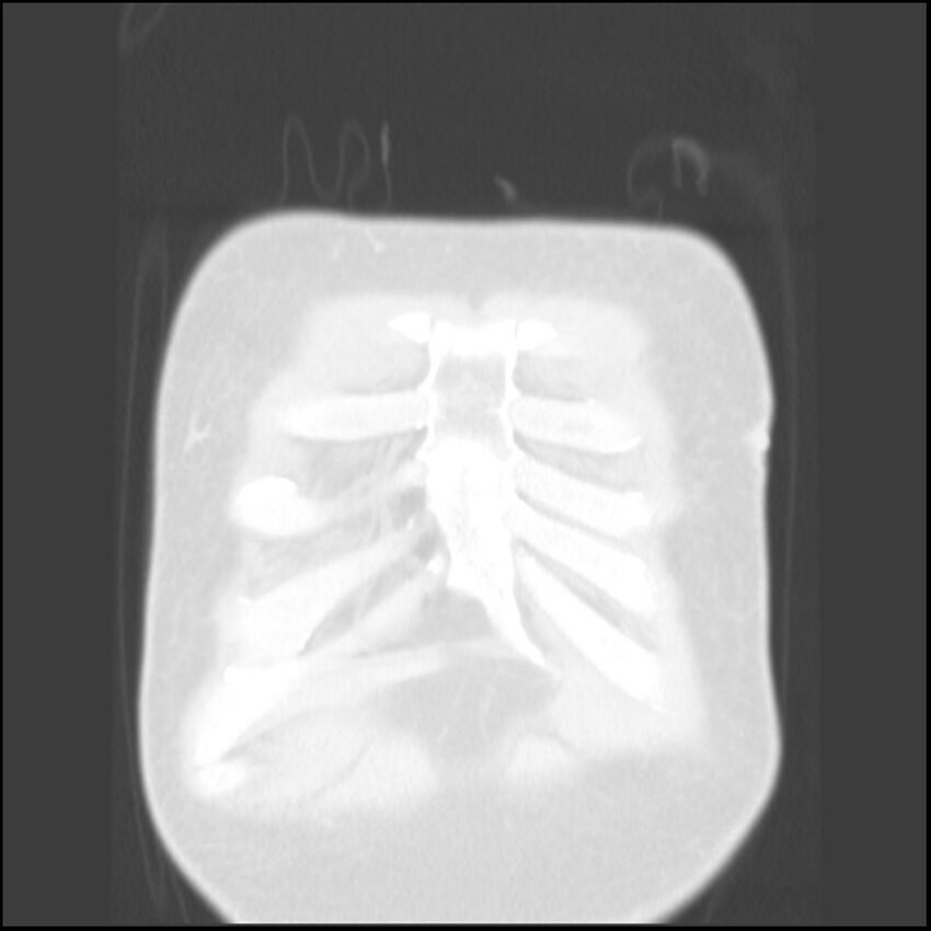 Angioinvasive aspergillosis (Radiopaedia 43957-47466 Coronal lung window 87).jpg