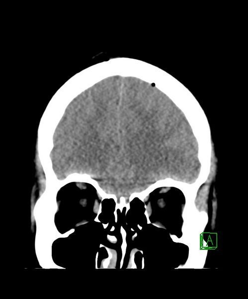 File:Angiomatous meningioma (Radiopaedia 79459-92578 Coronal non-contrast 10).jpg