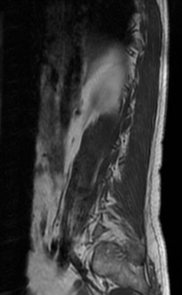 File:Ankylosing spondylitis - Andersson lesion (Radiopaedia 81878-95838 Sagittal T1 2).jpg