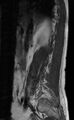 Ankylosing spondylitis - Andersson lesion (Radiopaedia 81878-95838 Sagittal T1 2).jpg