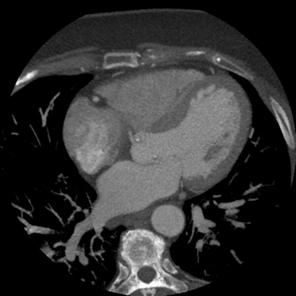 File:Anomalous origin of left circumflex artery from right coronary sinus (Radiopaedia 72563-83117 A 30).jpg
