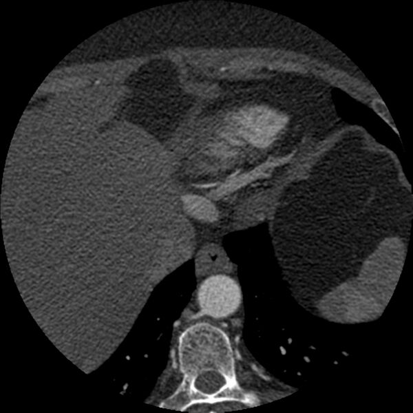 File:Anomalous origin of left circumflex artery from right coronary sinus (Radiopaedia 72563-83117 B 162).jpg