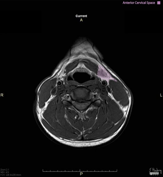 File:Anterior cervical space- annotated MRI (Radiopaedia 43831).png