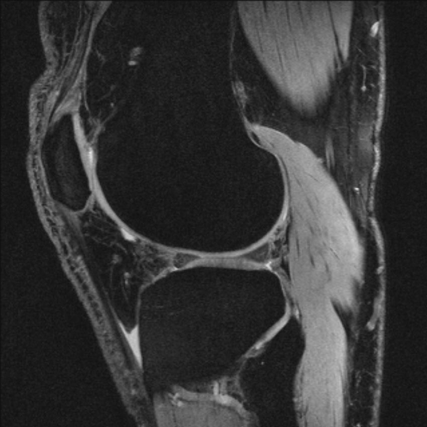 Anterior cruciate ligament mucoid degeneration (Radiopaedia 68400-77933 Sagittal 17).jpg