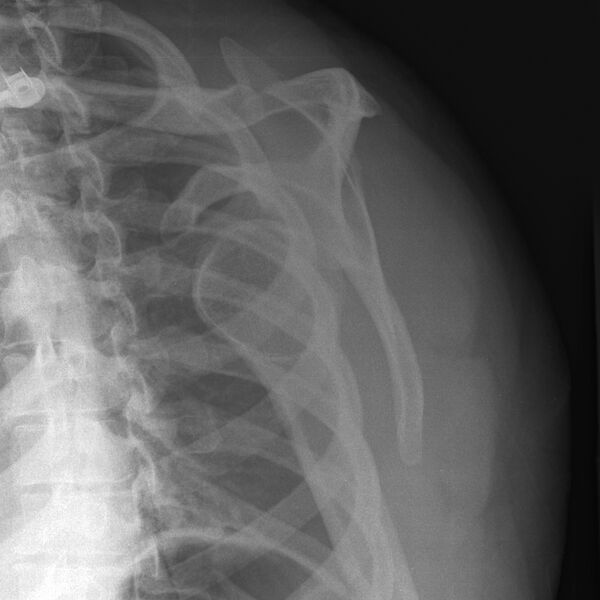 File:Anterior shoulder dislocation (Radiopaedia 10983-11401 Lateral 1).jpg