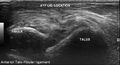 Anterior talofibular ligament injury (Radiopaedia 53338-59320 A 2).jpg