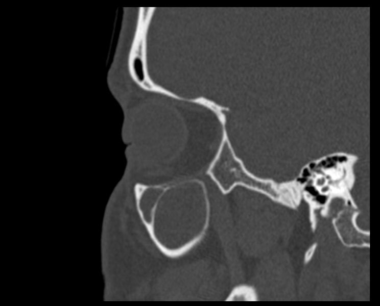 File:Antrochoanal polyp (Radiopaedia 21894-21868 Sagittal bone window 6).jpg