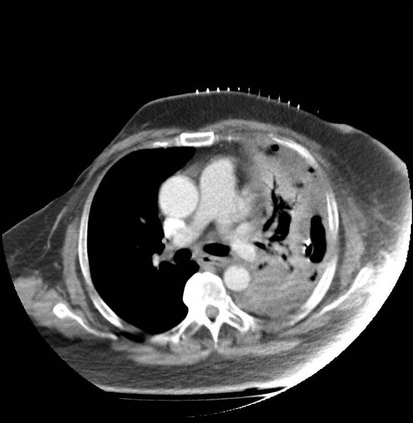 File:Aortic arch false aneurysm (Radiopaedia 14667-14588 A 12).jpg