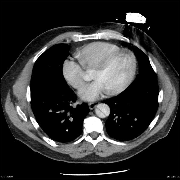 File:Aortic dissection- Stanford A (Radiopaedia 37759-39664 A 45).jpg