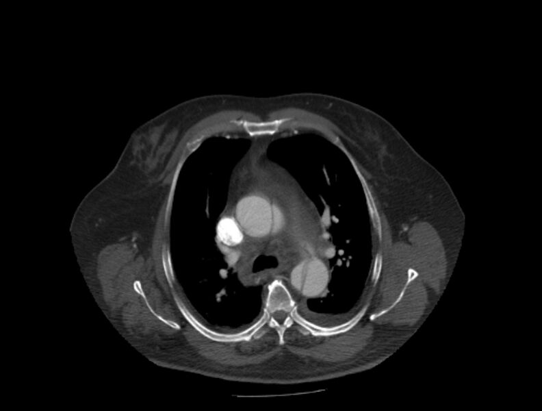 File:Aortic dissection (Radiopaedia 28802-29105 A 12).jpg