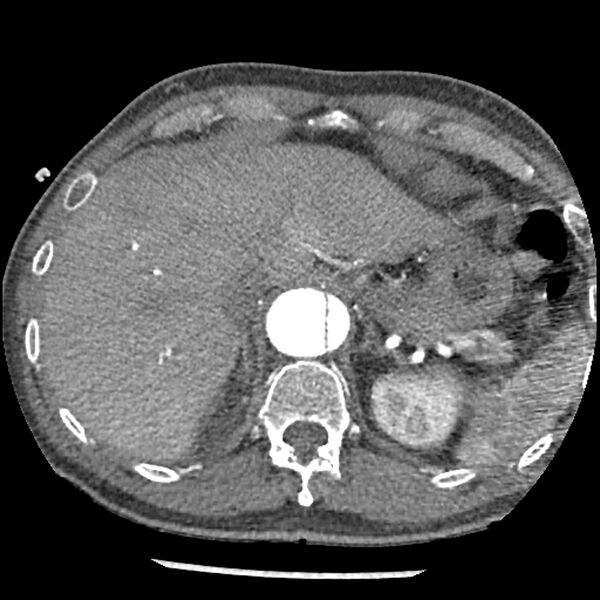 File:Aortic dissection - DeBakey Type I-Stanford A (Radiopaedia 79863-93115 A 37).jpg