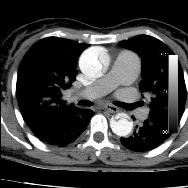 File:Aortic dissection - Stanford type A (Radiopaedia 29247-29659 A 35).jpg